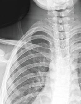 X-ray of person's chest